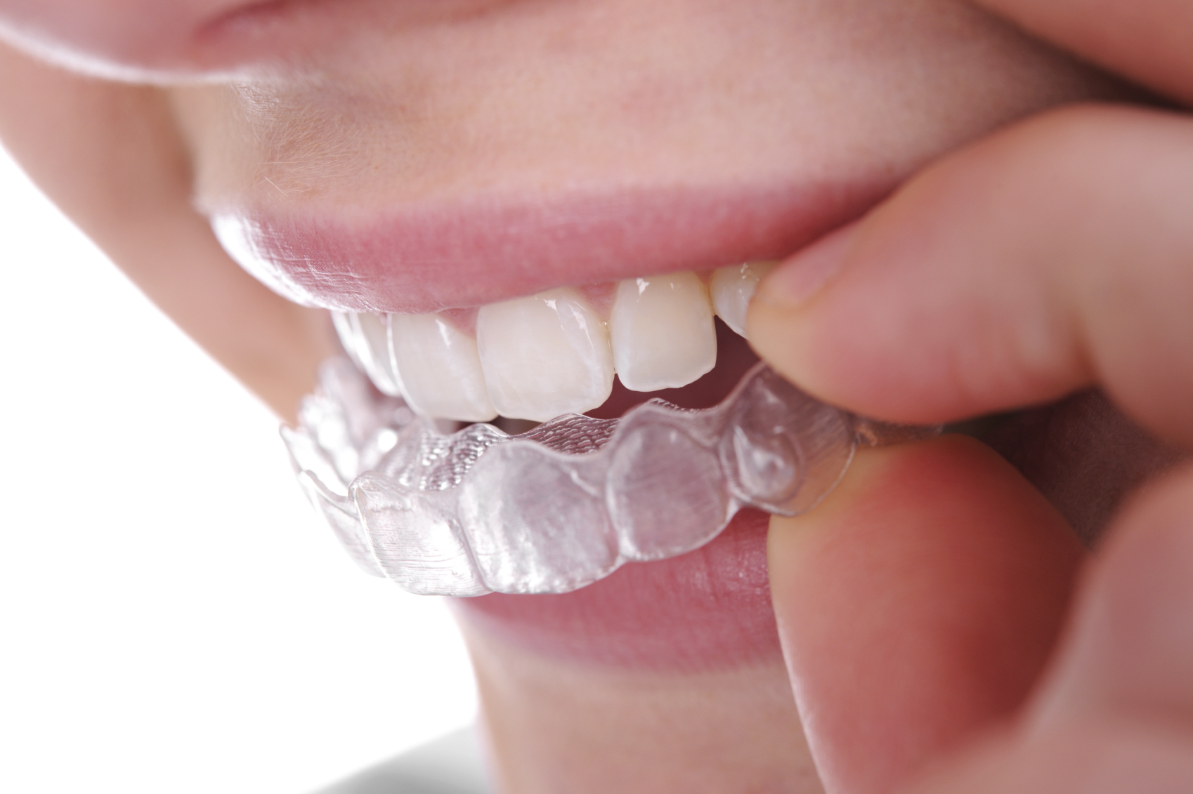 Invisalign Invisible Braces  Teeth Straightening Treatment